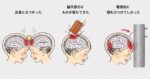 子供の頭部のケガは深刻　エポカル　株式会社ピーカブー